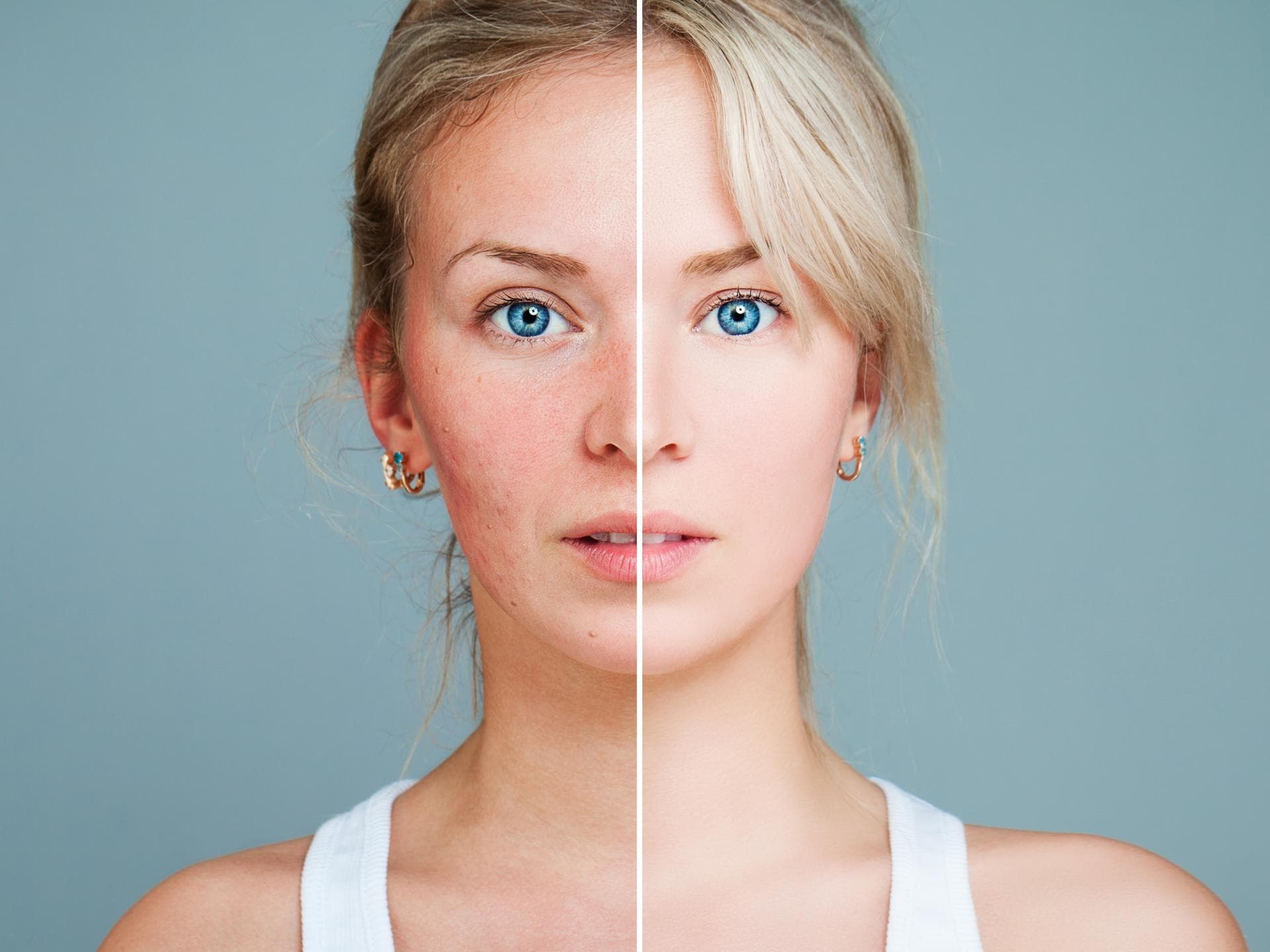 Rosacea: Die besten Cremes Junge Frau mit Rosacea und gesunder Haut, das Bild ist in der Mitte geteilt
